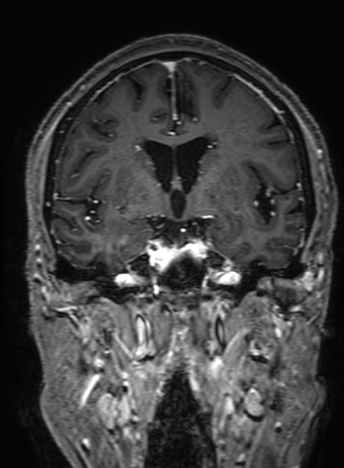 Cavernous hemangioma of the cerebellar falx (Radiopaedia 73025-83724 Coronal T1 C+ 170).jpg