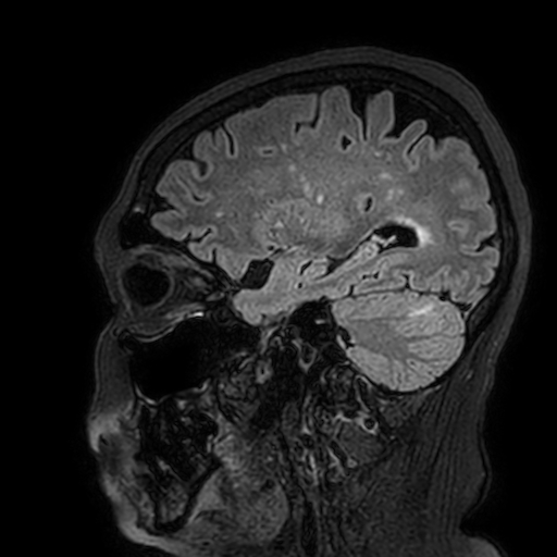 Cavernous hemangioma of the cerebellar falx (Radiopaedia 73025-83724 Sagittal FLAIR 60).jpg