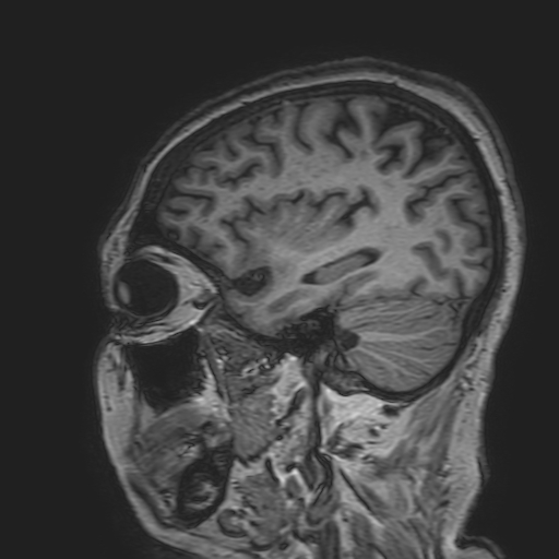 File:Cavernous hemangioma of the cerebellar falx (Radiopaedia 73025-83724 Sagittal T1 57).jpg