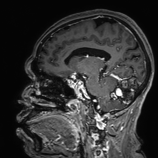 Cavernous hemangioma of the cerebellar falx (Radiopaedia 73025-83724 Sagittal T1 C+ 123).jpg
