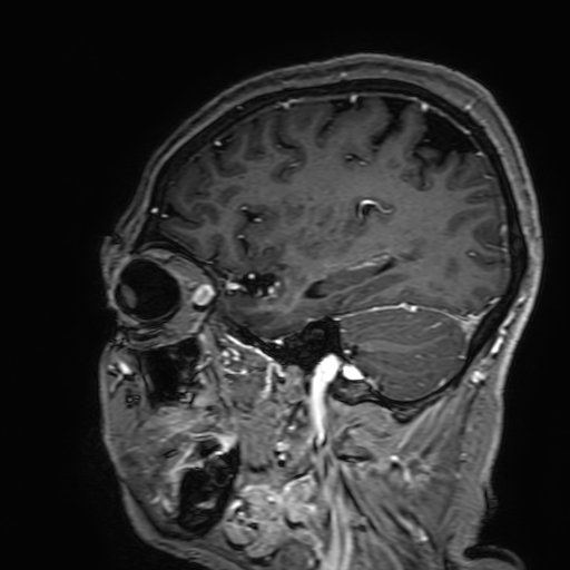 Cavernous hemangioma of the cerebellar falx (Radiopaedia 73025-83724 Sagittal T1 C+ 155).jpg