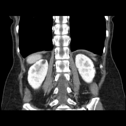 Cavernous hepatic hemangioma (Radiopaedia 75441-86667 C 109).jpg