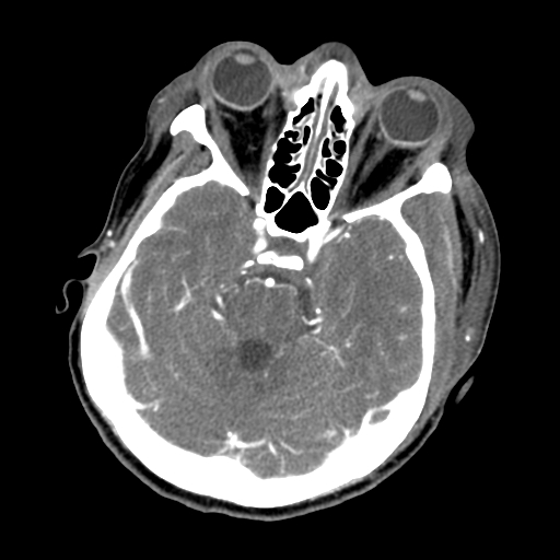 File:Cavernous sinus thrombosis (Radiopaedia 10619-11078 A 4).jpg