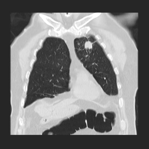 File:Cavitating pulmonary metastases (Radiopaedia 89545-106544 Coronal lung window 10).jpg