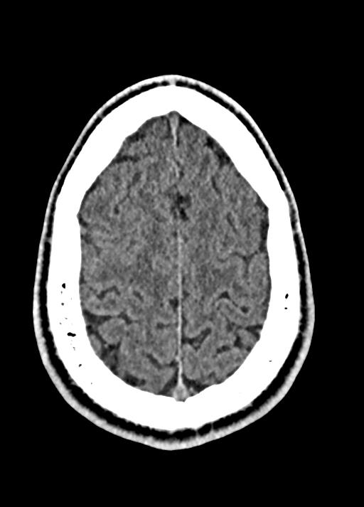 Cavum septum pellucidum and cavum vergae (Radiopaedia 77797-90060 Axial Brain Window 86).jpg