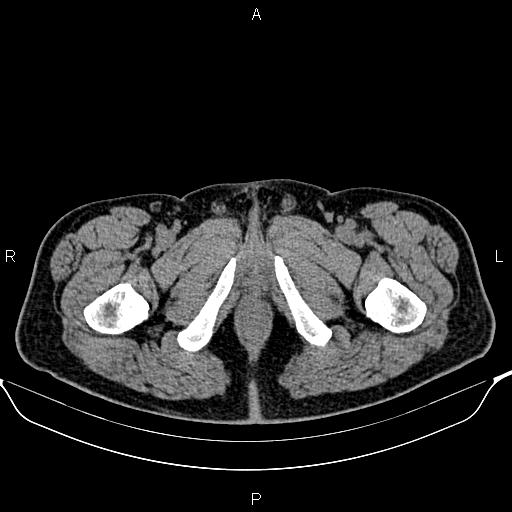 Cecal adenocarcinoma (Radiopaedia 85324-100916 Axial non-contrast 108).jpg