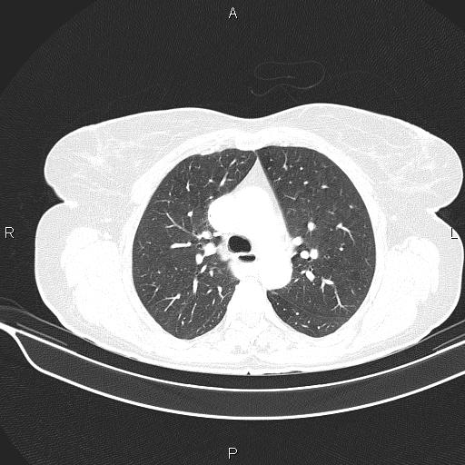 Cecal cancer (Radiopaedia 85610-101358 Axial lung window 23).jpg