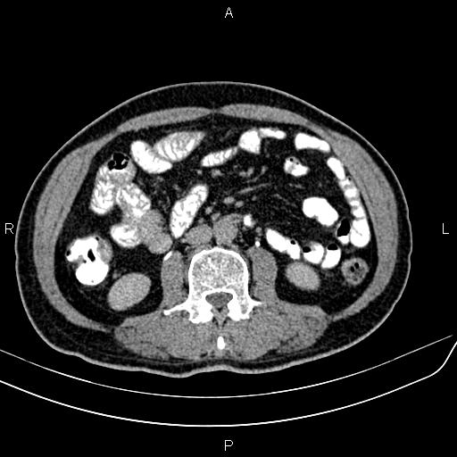 File:Cecal cancer with appendiceal mucocele (Radiopaedia 91080-108651 Axial C+ delayed 34).jpg