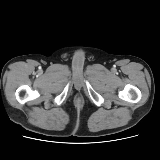 File:Cecal mass causing appendicitis (Radiopaedia 59207-66531 A 97).jpg