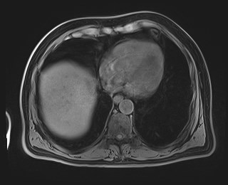 Cecal mass causing appendicitis (Radiopaedia 59207-66532 Axial T1 18).jpg