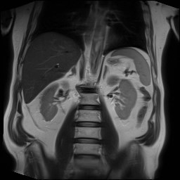 File:Cecal mass causing appendicitis (Radiopaedia 59207-66532 Coronal T2 23).jpg