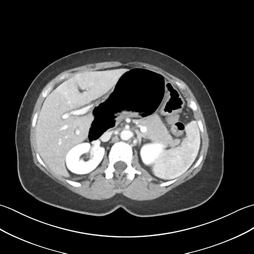 Cecum hernia through the foramen of Winslow (Radiopaedia 46634-51112 A 22).png