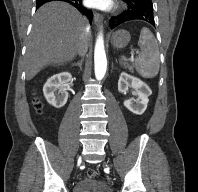 Celiac artery dissection (Radiopaedia 52194-58080 C 89).jpg