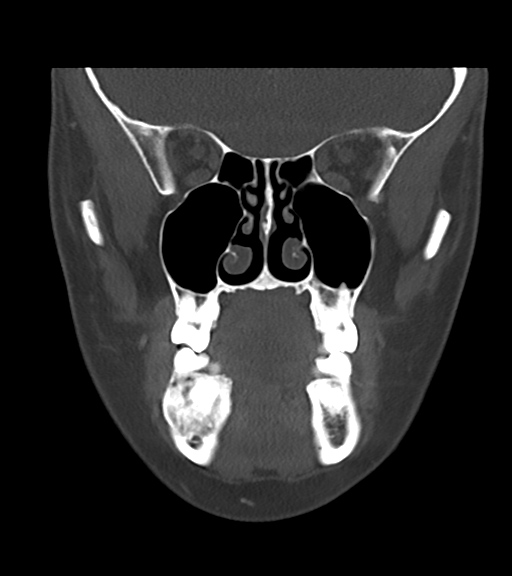 Cemento-ossifying fibroma (Radiopaedia 46243-50643 Coronal bone window 23).png