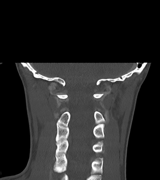 Cemento-ossifying fibroma (Radiopaedia 46243-50643 Coronal bone window 48).png