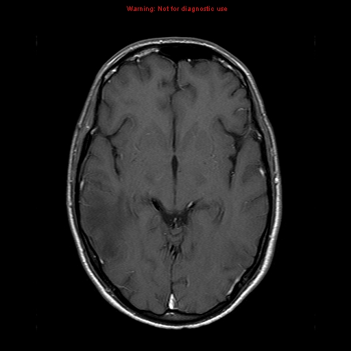 File:Central nervous system vasculitis (Radiopaedia 8410-9235 Axial T1 C+ 11).jpg