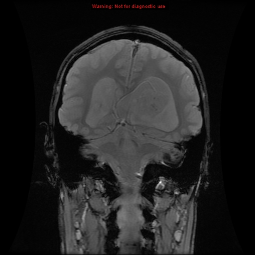 File:Central neurocytoma (Radiopaedia 13188-13206 G 4).jpg