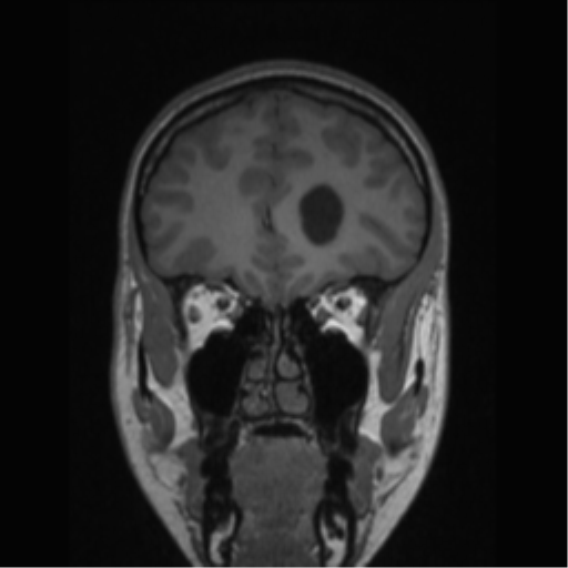 Central neurocytoma (Radiopaedia 37664-39557 Coronal T1 69).png