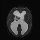 Central neurocytoma (Radiopaedia 56690-63469 Axial DWI 10).jpg