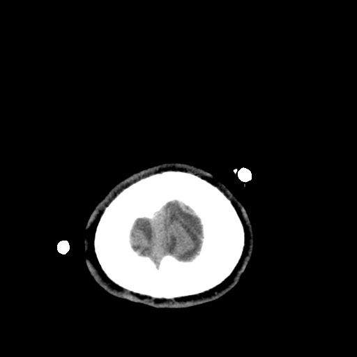 Central neurocytoma (Radiopaedia 68725-78432 Axial non-contrast 53).jpg