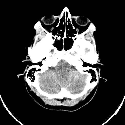Central neurocytoma (Radiopaedia 84497-99871 Axial non-contrast 6).jpg