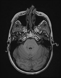 Central neurocytoma (Radiopaedia 84497-99872 Axial T1 60).jpg