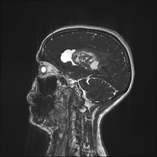 Central neurocytoma (Radiopaedia 84497-99872 Sagittal CISS 25).jpg