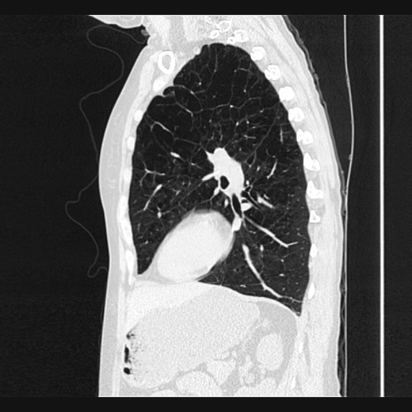 Centrilobular pulmonary emphysema (Radiopaedia 24495-24789 Sagittal lung window 54).jpg