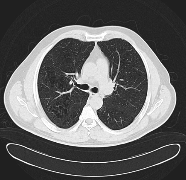 Centrilobular pulmonary emphysema (Radiopaedia 26808-26971 C 19).jpg