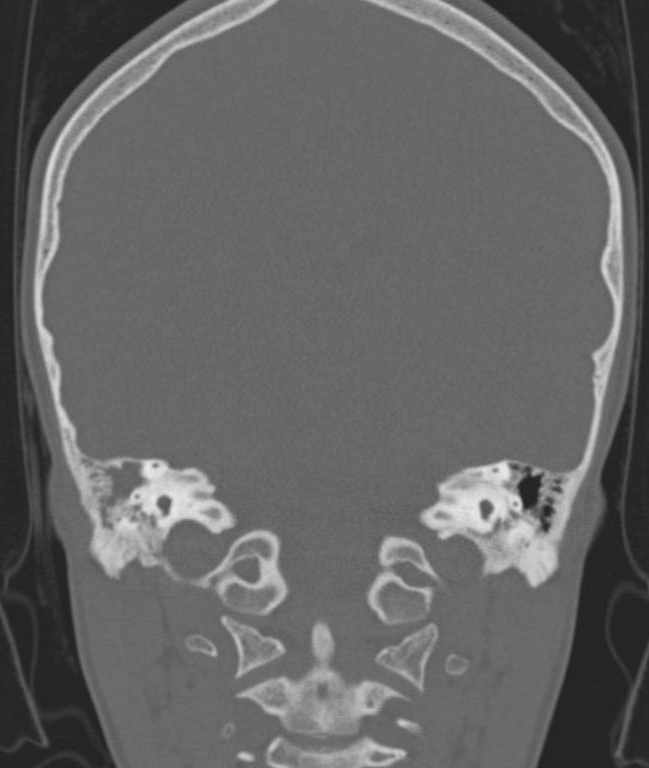 Cerebellar abscess (Radiopaedia 73727-84527 Coronal bone window 51).jpg