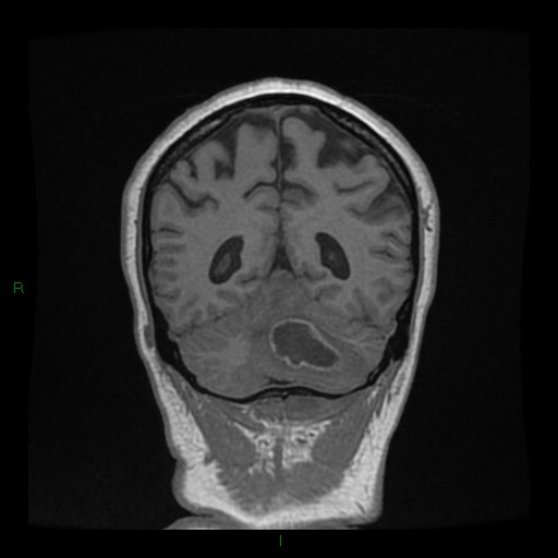 Cerebellar abscess (Radiopaedia 78135-90678 Coronal T1 C+ 121).jpg