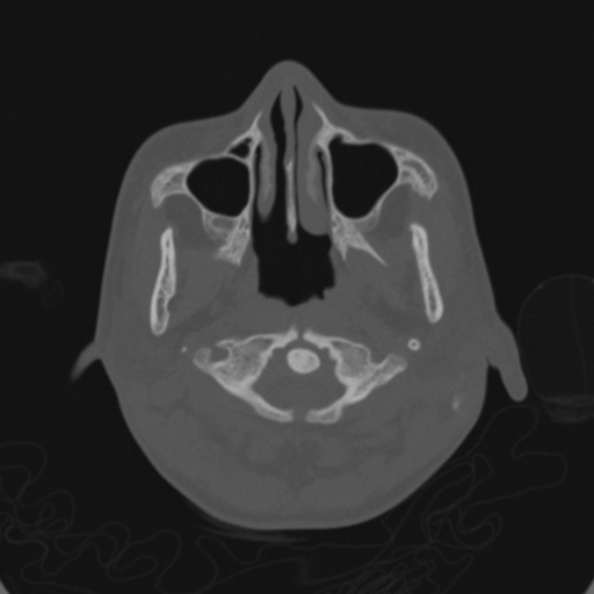 Cerebellar abscess secondary to mastoiditis (Radiopaedia 26284-26413 Axial bone window 3).jpg