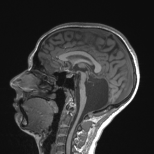 Cerebellar agenesis with hypoplastic pons (pontocerebellar hypoplasia) (Radiopaedia 57224-64138 Sagittal T1 36).png