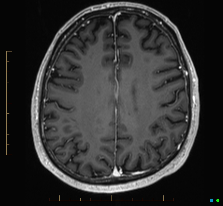 Cerebellar gangliocytoma (Radiopaedia 65377-74422 Axial T1 C+ 95).jpg