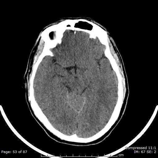 Cerebellar hemangioblastoma (Radiopaedia 52360-58258 Axial non-contrast 53).jpg