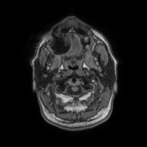 File:Cerebellar hemangioblastoma (Radiopaedia 88055-104622 Axial T1 4).jpg