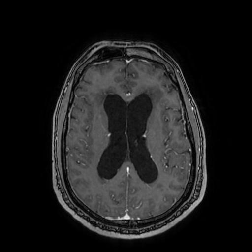 Cerebellar hemangioblastoma (Radiopaedia 88055-104622 Axial T1 C+ 108).jpg
