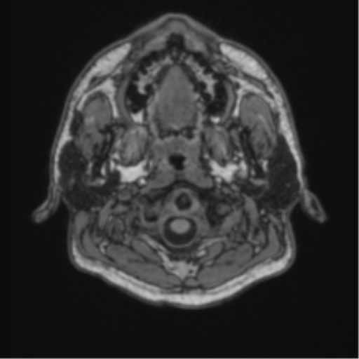 Cerebellar hemangioblastomas and pituitary adenoma (Radiopaedia 85490-101176 Axial T1 1).png