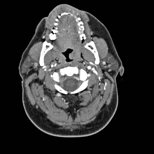 Cerebellar infarct due to vertebral artery dissection with posterior fossa decompression (Radiopaedia 82779-97029 C 67).png