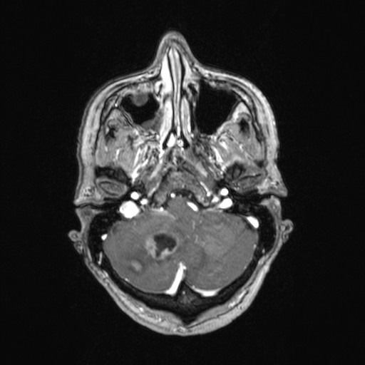 File:Cerebellar metastases (Radiopaedia 24038-24249 Axial T1 C+ 45).jpg