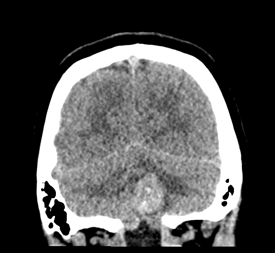 Cerebellar metastases - colorectal adenocarcinoma (Radiopaedia 40947-43652 Coronal non-contrast 76).png