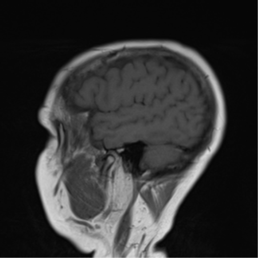 File:Cerebellar metastasis (Radiopaedia 54578-60810 Sagittal T1 3).png