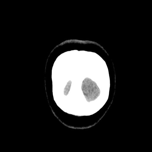 File:Cerebellar metastasis (cystic appearance) (Radiopaedia 41395-44258 Coronal non-contrast 60).png