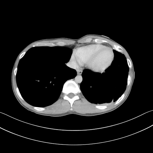 Cerebellar metastasis - adenocarcinoma lung (Radiopaedia 63184-71717 Axial C+ delayed 52).png