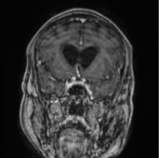 Cerebellar metastasis from lung adenocarcinoma (Radiopaedia 86690-102829 Coronal T1 C+ 65).png