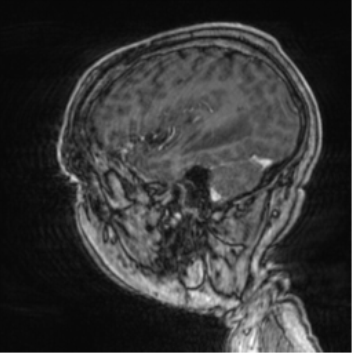 Cerebellar metastasis from lung adenocarcinoma (Radiopaedia 86690-102829 Sagittal T1 C+ 19).png