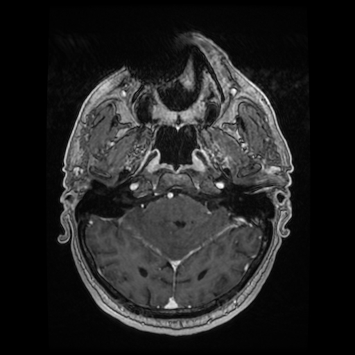 Cerebellar metastasis of pulmonary adenocarcinoma, cavernous venous malformation, and developmental venous anomaly (Radiopaedia 85827-101661 Axial T1 C+ 32).jpg