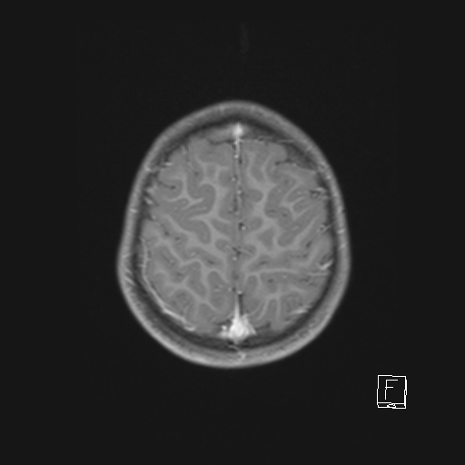 Cerebellar stroke (Radiopaedia 32202-33150 Axial T1 C+ 58).png