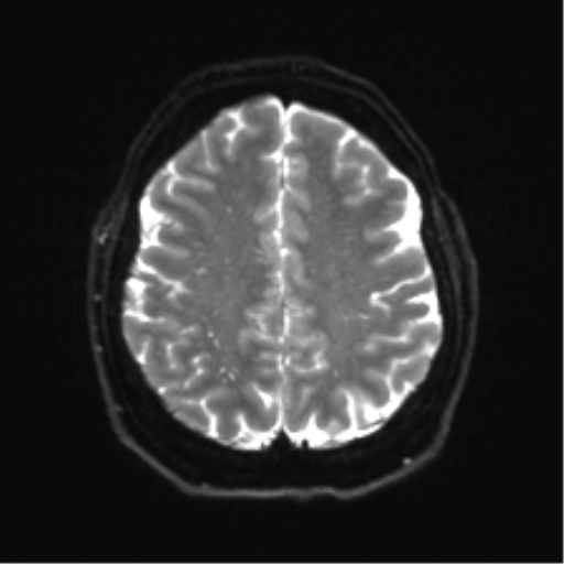 Cerebellopontine angle meningioma (Radiopaedia 48434-53348 Axial DWI 29).png