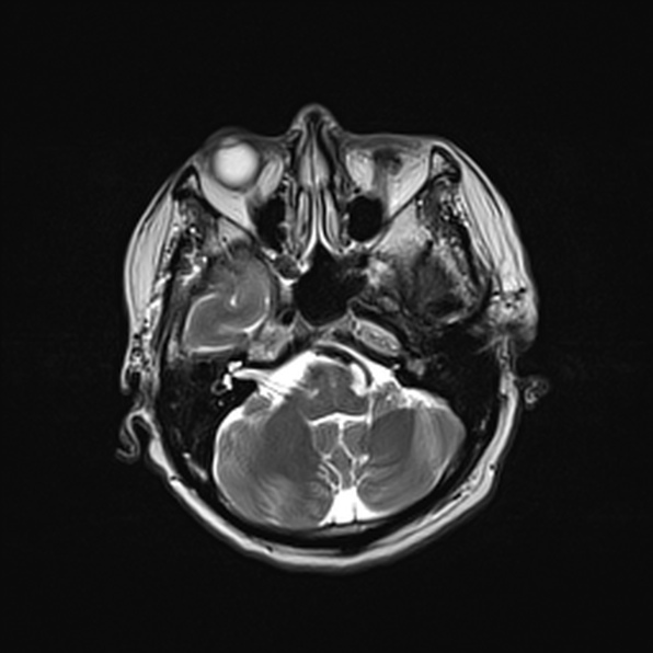 Cerebral abscess (Radiopaedia 26111-26247 Axial T2 18).jpg